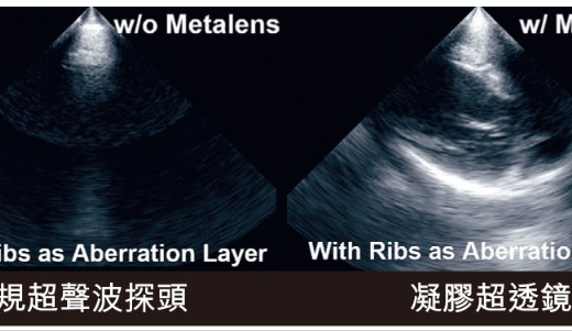 港大研發「動態控制超透鏡」 突破超聲波肋骨屏障 提升診療精準度
